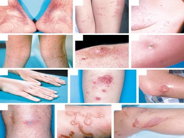 Bệnh sán chó Toxocara: Nguyên nhân, triệu chứng và điều trị
