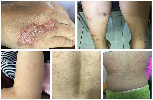 Nổi Mẩn Ngứa Khắp Người: Nguyên Nhân, Chẩn Đoán & Cách Trị